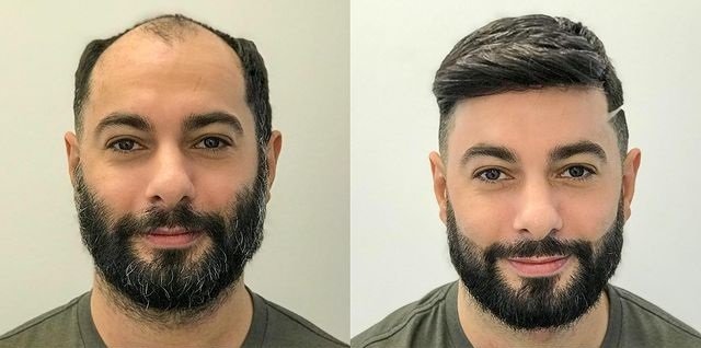Natural Hairline Design