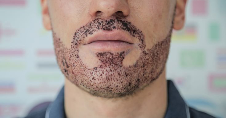 Beard Transplant