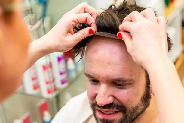 Hair Patch Treatment
