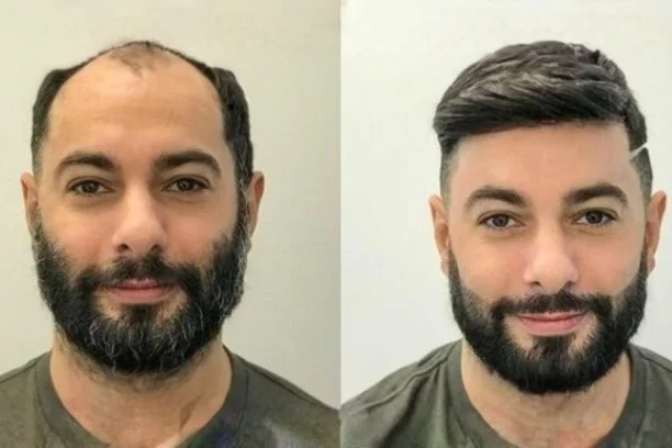 Natural Hairline Design