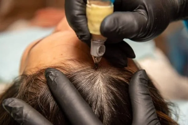 Scalp Micropigmentation
