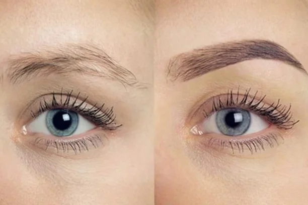 Eyebrow Transplant