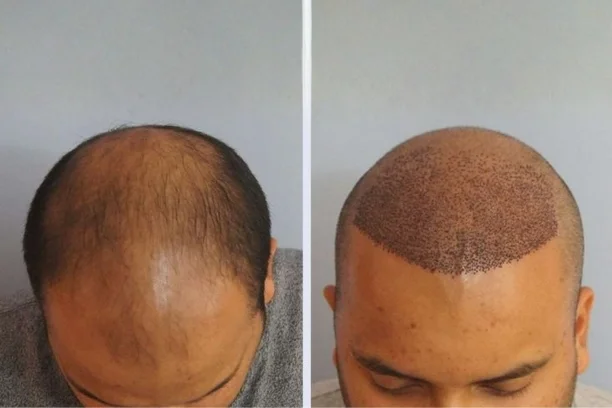 Hair transplant