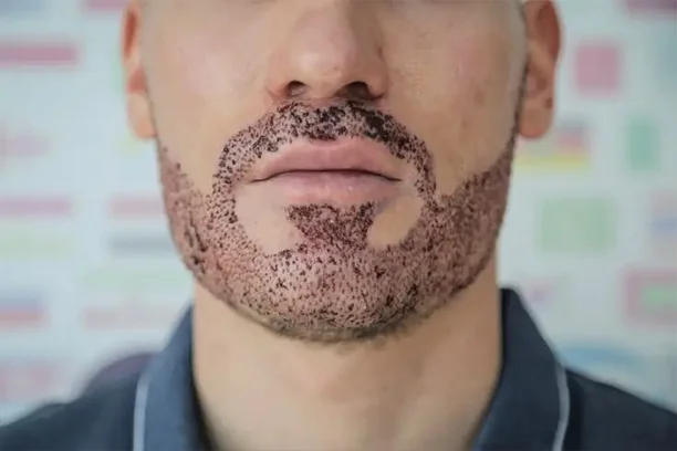 Beard Transplant